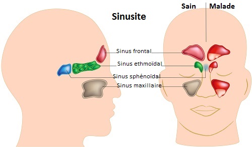 comment soigner naturellement une sinusite