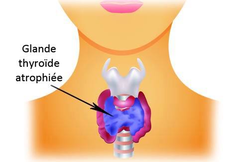 L’hypothyroïdie : comment prendre soin de sa thyroïde