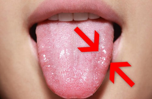 comment guerir mycose langue