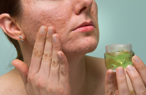 Comment éliminer les marques de l’acné avec des remèdes naturels