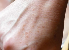 De la pigmentation sur la personne les meilleur de la crème pour