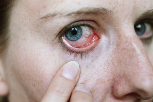 comment eviter d avoir les yeux rouges