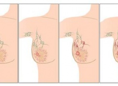 most cancers poumon non petites cellules tumeur villeuse colique