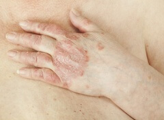 Le psoriasis de la variété de la maladie de la photo
