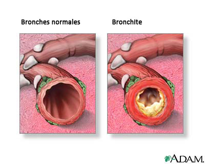 Traitement naturel de la bronchite