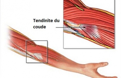 Comment soulager les symptômes de la tendinite