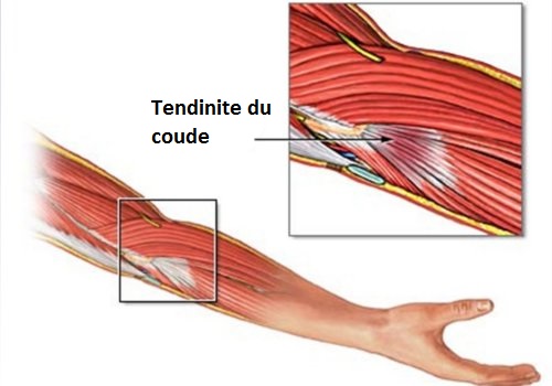 Tendinite