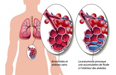 7 aliments pour soigner la pneumonie