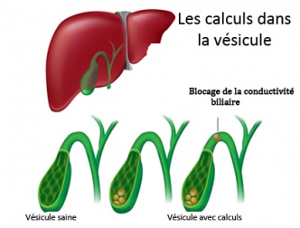 Quels sont les symptômes des calculs de la vésicule ?
