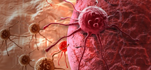 Les symptômes d'un possible cancer chez les femmes
