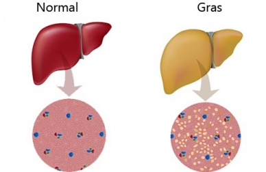 Conseils pour soigner un foie trop gras