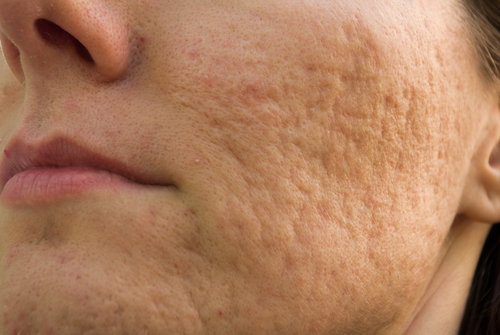 Les cicatrices d'acné laissent des traces sur la peau