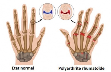Traitements naturels pour soigner l'arthrite