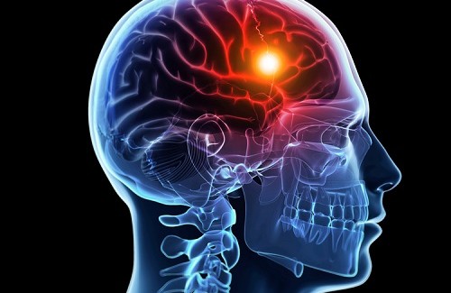 Comment prévenir un accident vasculaire cérébral ?
