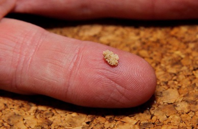 Remèdes maison pour dissoudre des calculs rénaux