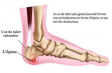 Comment faire pour prévenir une épine calcanéenne ?