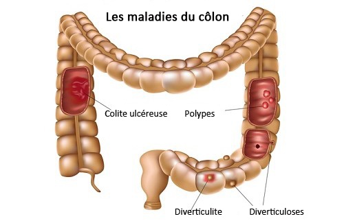 Les douleurs à gauche au côté fait mal les reins écoeure