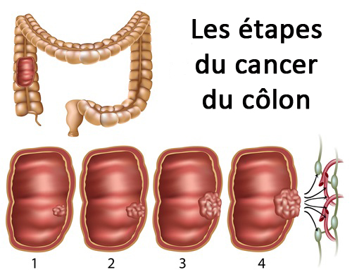 Les étapes du cancer du colon 
