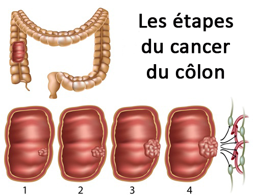 Les étapes du cancer du colon