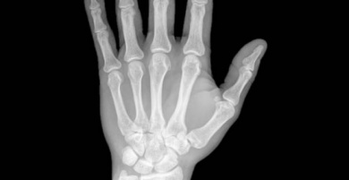 Peut-on soigner l'arthrite rhumatoïde ?