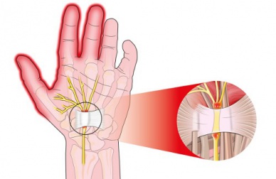 Le syndrôme du canal carpien : causes et solutions
