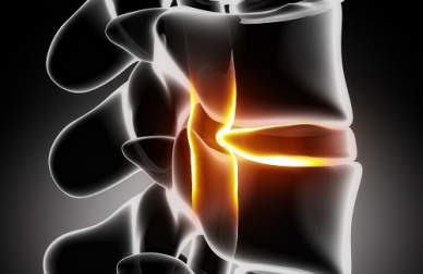 Prévention et traitement de la sciatique