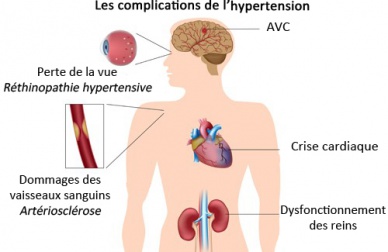 Les aliments pour combattre l'hypertension artérielle