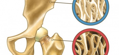 Comment prévenir l'ostéoporose naturellement