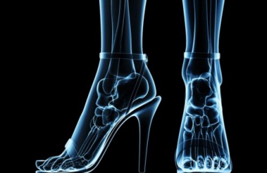 Abuser des talons : les conséquences sur la santé
