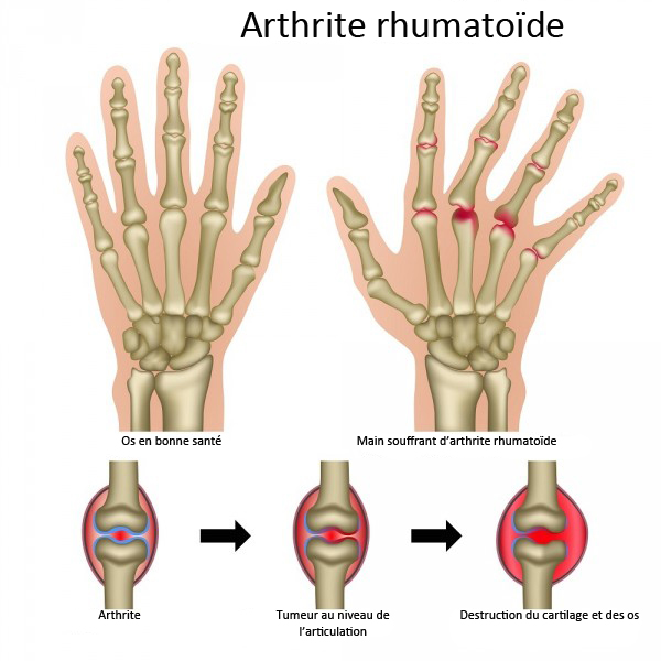 Différentes formes d'une arthrite rhumatoïde.