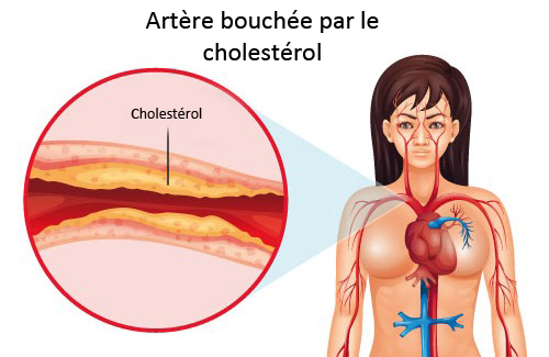 Ce qu’il faut faire pour contrôler le cholestérol