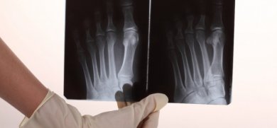 Douleur osseuse : causes et remèdes naturels