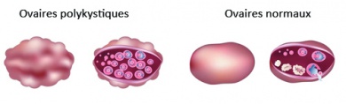 Le Syndrome Des Ovaires Polykystiques - Améliore Ta Santé