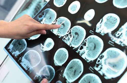 7 habitudes pour prévenir la maladie d'Alzheimer