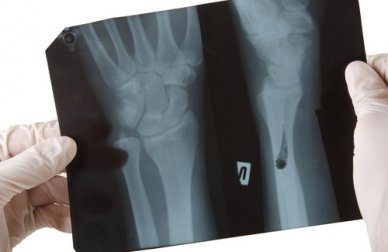 Renforcez vos os avec du calcium d'origine végétale !