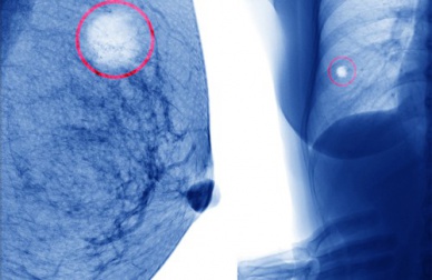 Comment éviter les kystes du sein ?