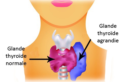 L'hyperthyroïdie chez les femmes