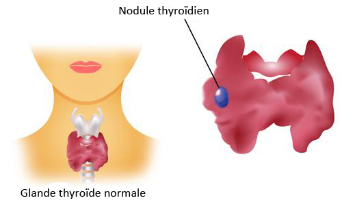 Comment savoir si les nodules thyroïdiens sont bénins ou malins ?