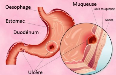 Ulcère gastro-duodénal : les traitements naturels