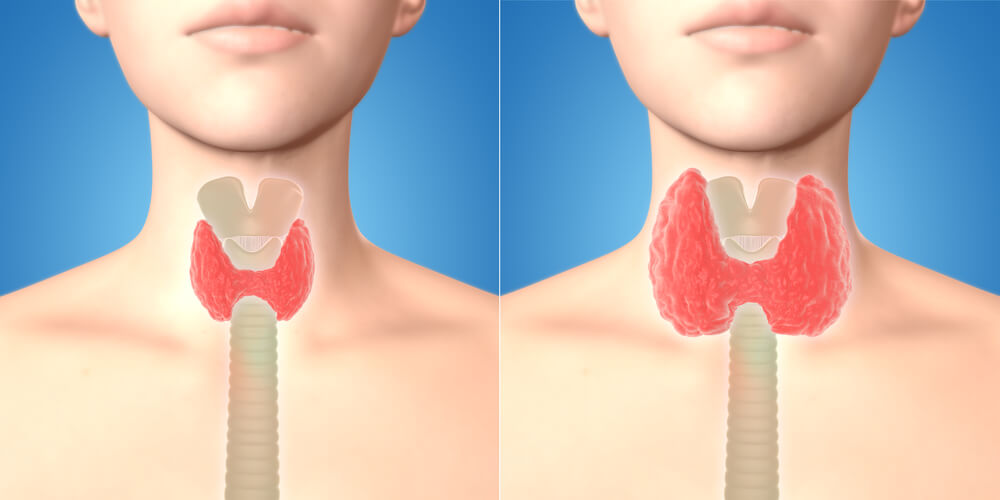 Les causes possibles et les remèdes de la thyroïdite - Améliore ta Santé