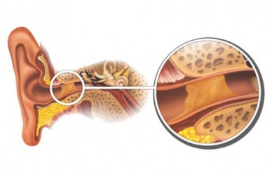 Éliminer les bouchons de cérumen de façon naturelle