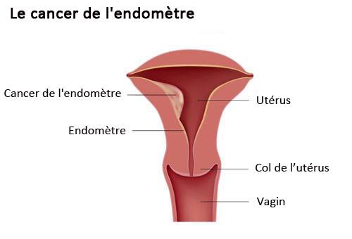 Développement du cancer de l'endomètre.