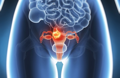 Le cancer de l'utérus peut être évité dans 60% des cas