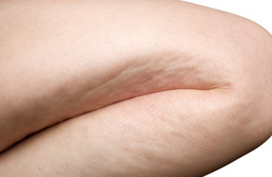 Des exercices simples pour éliminer la cellulite