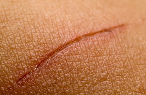 Comment éliminer ou atténuer les cicatrices ?