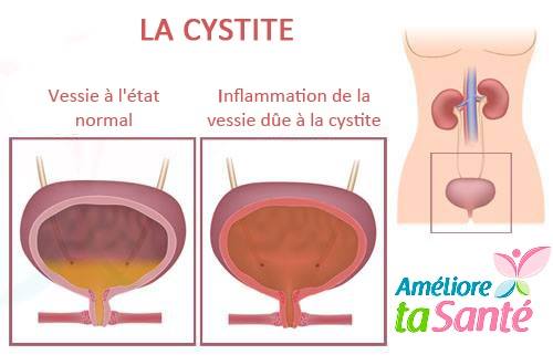 la cystite peut causer une miction douloureuse