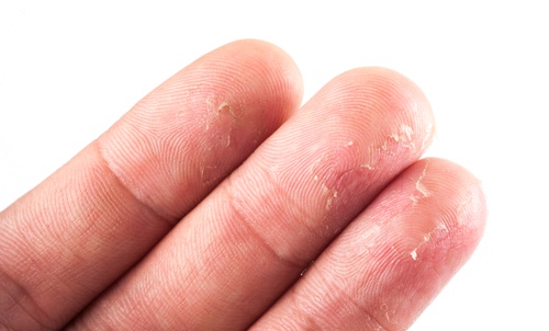 Los primeros indicios atopicheskogo de la dermatitis surgen