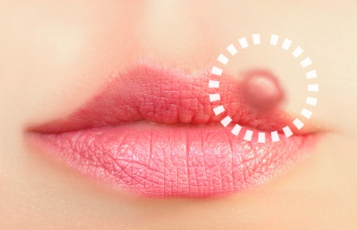 Des solutions naturelles contre l'herpès labial