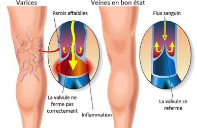 Des astuces naturelles pour lutter contre les varices