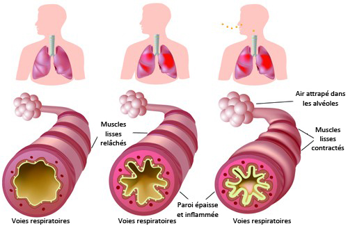 Que faire en cas d’asthme chronique et d’allergies ?